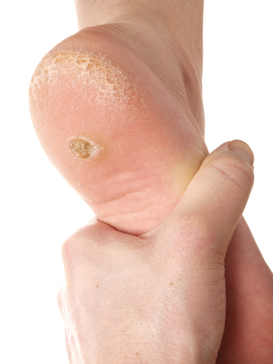 Plantar Warts All Ages Podiatry And Mobility