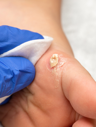 plantarwart plantarwart